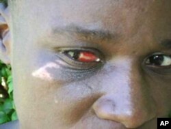 A farm worker in Zimbabwe with injuries to her face and eyes after she was beaten, allegedly by Zanu-PF supporters