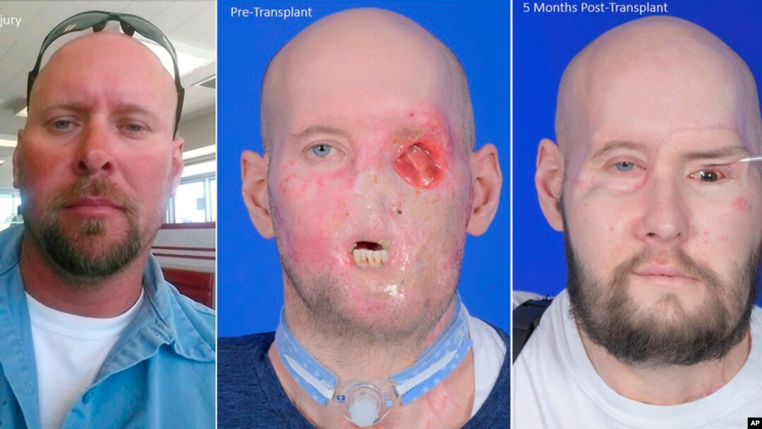 Kombinacija fotografija Džejmsa pre nesreće i nakon transplantacije lica i oka (Foto: AP/NYU Langone Health)