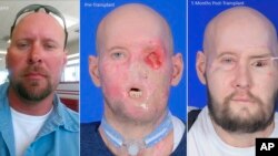 This combination of photos provided by NYU Langone Health in November 2023 shows Aaron James before and after his high-voltage electricity accident and after a facial and eye transplant.