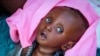 FILE - Malnourished Tiere Pascol, 5 months, whose mother can't afford food and has trouble breastfeeding, lies in his mother's arms at a feeding center in Al Sabah Children's Hospital in Juba, South Sudan, Dec. 3, 2020. 