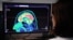 Escáner del cerebro de una persona en una pantalla de un hospital de Brest, al oeste de Francia.