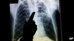 Los tumores pulmonares son detectados con frecuencia por medio de Rayos X o tomografías computarizadas.