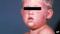 A child with measles.