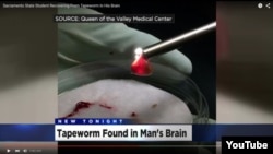 California man suffers from tapeworm in his brain. (Screen shot from CBS News via YouTube)