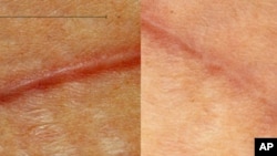 Volunteer patient who had abdominal surgery, with the left side showing the incision closed normally and the right side showing the incision closed with the new scar-reducing bandage