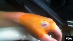 Seorang pasien di AS yang baru saja ditanamkan 'microchip' di bawah kulit tangannya (foto: dok).