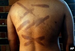 FILE - In this July 18, 2017, file photo, a Sri Lankan man known as Witness #199 shows the scars on his back during an interview in London. He is one of more than 50 ethnic Tamil men seeking political asylum in Europe, after they were, they said, abducted and tortured under Sri Lanka's current regime.