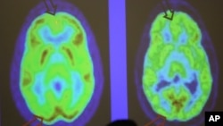 PET scanners displays areas of the body in different colors to show disease and conditions. A new PET scanner shows the entire body at once, rather just its parts, like the brain. 