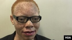 Tapiwa Gwen Marange, a 34-year-old albino woman, says more education is needed for Zimbabwe traditional healers to stop promoting myths about albinism. (S. Mhofu/VOA)