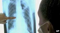 An x-ray of the lungs of a TB patient
