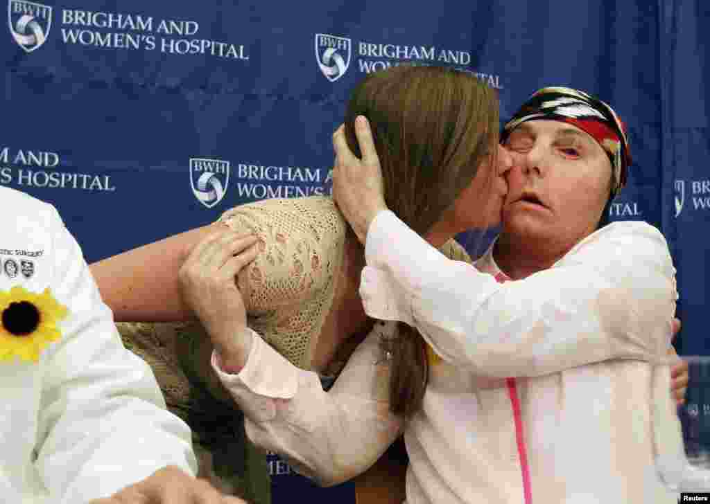 Marinda Righter (L), daughter of face donor Cheryl Denelli-Righter, kisses face transplant recipient Carmen Blandin Tarleton during a news conference at Brigham and Women&#39;s Hospital in Boston, Massachusetts. Tarleton, who was attacked by her estranged husband and doused with lye in June 2007, underwent the transplant in February.