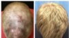 Arthritis Drug Spurs Hair Growth on Bald Man's Head