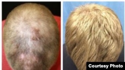 Hair growth on a patient's head is seen five months into treatment and eight months into treatment. (Yale University)