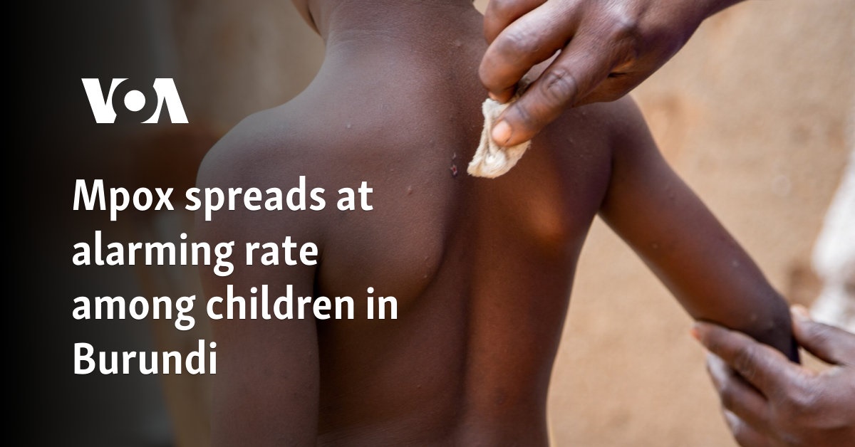 Mpox spreads at alarming rate among children in Burundi