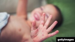 Un niño con síntomas de sarampión en sus manos, pies, y boca. Foto sin fecha.