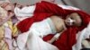 Un garçon souffrant de malnutrition à l’hôpital al-Sabeen à Sanaa, au Yémen, le 10 septembre 2018.