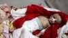 Yemenis Starving as Aid System Fails