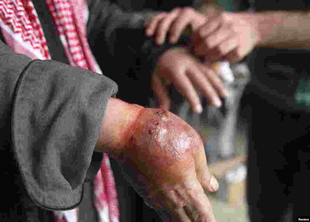 A man with a hand showing symptoms of leishmaniasis waits to be treated at a hospital in Aleppo, Syria, February 11, 2013. 