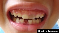 Gigi yang ditumbuhkan dari proses itu hanya memiliki sepertiga dari tingkat kekerasan gigi dewasa. (Foto: Ilustrasi)