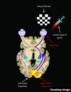 Being a bilateral disease, visual pathways in LCA2 patients on both sides are atrophied due to lack of visual inputs. After reinstating vision by injection of good copies of the gene, visual pathways from the injected area to the brain strengthen over time. Hence there is an asymmetrical brain response showing much larger activations in the retina-brain pathway from the injected eye when each eye is exposed to visual stimuli. (Credit: Illustrated by Elena Nikonova)