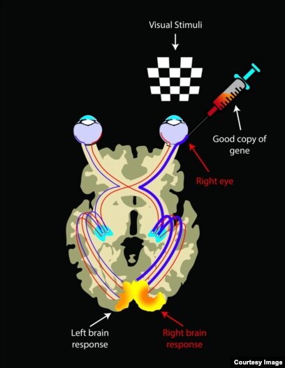 Study: Brains of the Blind Adjust After Vision-restoring Therapy