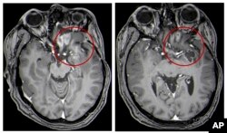 This combination of MRI images provided by the University of Alabama in April 2021 shows scans of a child with a brain tumor, before and after the treatment.