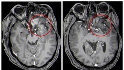 Quiz - Unusual Treatment Shows Promise for Kids With Brain Tumors