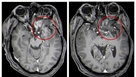 This combination of MRI images provided by the University of Alabama in April 2021 shows scans of a child with a brain tumor, before and after the treatment.