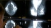 Study: 3-D Mammograms Offer Improved Diagnosis