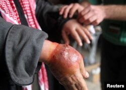 FILE - A man with a hand showing symptoms of leishmaniasis waits to be treated at a hospital in Aleppo, Syria, Feb. 11, 2013.