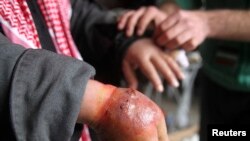 FILE - A man with a hand showing symptoms of leishmaniasis waits to be treated at a hospital in Aleppo, Syria, Feb. 11, 2013.