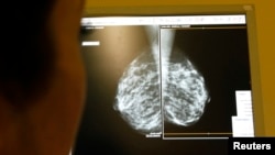 FILE - A doctor exams mammograms, a special type of X-ray of the breasts, which are used to detect tumors, in Nice, France, Jan. 4, 2008.