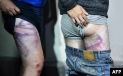 FILE - People detained during rallies of opposition supporters, who accuse Alexander Lukashenko of falsifying the polls in the presidential election, show bruises as they leave the Okrestina prison in Minsk, Aug. 14, 2020.