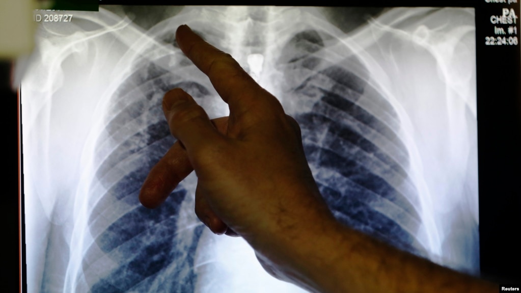 Um mÃ©dico aponta para um raio X que mostra pulmÃµes com tuberculose, uma das doenÃ§as que afectam os mineiros. 