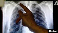 FILE - A doctor points to an X-ray showing a pair of lungs infected with tuberculosis on board a mobile X-ray unit screening for TB in London, Jan. 2014.