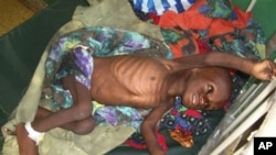 Uma criança com dois anos de idade, Abdirahman Arale, fotografada, na semana passada, no hospital de Banadir, em Mogadíscio
