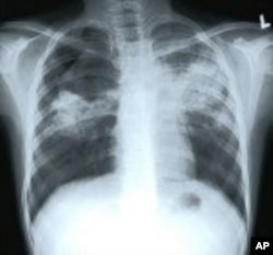 X-ray of patient with tuberculosis
