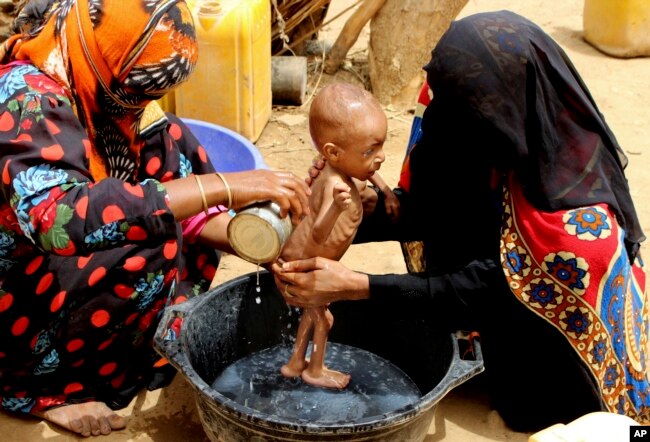 Seorang bayi yang menderita gizi buruk parah sedang dimandikan di Aslam, Hajjah, Yaman, 25 Agustus 2018.