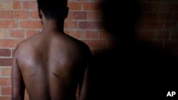 FILE - A Sri Lankan man known as Witness #205 shows the scars on his back during an interview in London, July 20, 2017. 