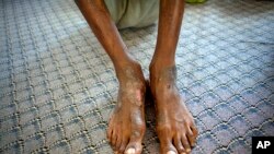 UN détenu dans une prison de Misrata, en Libye, montrant des plaies sur ses jambes, provoquées, selon lui, par les sévices auxquels il aurait été soumis