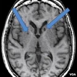 Hasil MRI atas otak pasien yang pernah terkena stroke dua kali. Panah menunjukkan adanya bintik-bintik gelap yang dulunya adalah sel-sel sehat yang mati akibat gumpalan darah yang masuk ke otak.