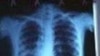 Tens of Millions of TB Patients Cured