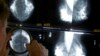 Radiolog koristi lupu kako ne bi propustio da otkrije rak dojke dok pregleda mamograme 