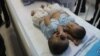 Bayi Kembar Siam di Medan Berhasil Dipisahkan Tepat di Hari Anak Nasional