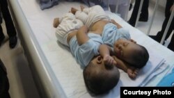 Bayi kembar siam dempet perut asal Tapanuli Utara, Sumatera Utara, sebelum menjalani operasi pemisahan di Rumah Sakit Umum Pusat H Adam Malik Medan. (Courtesy: Humas RSUP H Adam Malik)