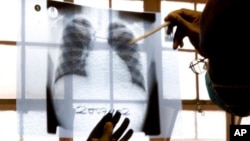 FILE - A doctor examines chest X-rays at a tuberculosis clinic in Gugulethu, Cape Town, South Africa.