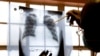 FILE - A doctor examines chest X-rays at a tuberculosis clinic in Gugulethu, Cape Town, South Africa in 2007.