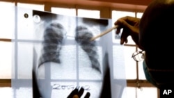 FILE - A doctor examines chest X-rays at a tuberculosis clinic in Gugulethu, Cape Town, South Africa in 2007.
