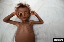 FILE - A malnourished boy lies on a bed outside his family's hut in al-Tuhaita district of the Red Sea province of Hudaydah, Yemen, Sept. 26, 2016.