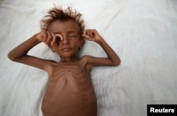 A malnourished boy lies on a bed outside his family's hut in al-Tuhaita district of the Red Sea province of Hudaydah, Yemen, Sept. 26, 2016.